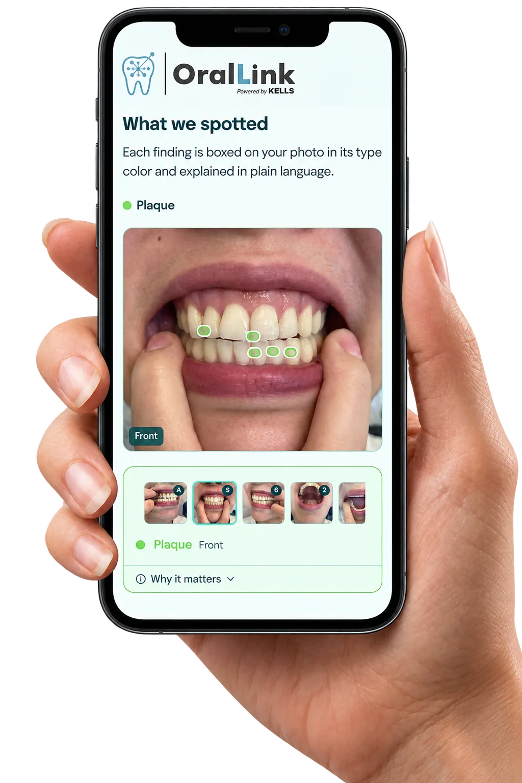 OralLink AI dental screening report on a phone